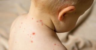 Saiba como identificar agentes causadores de alergias nos bebês