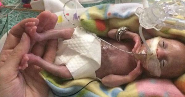 Menor bebê prematura do mundo completa três anos