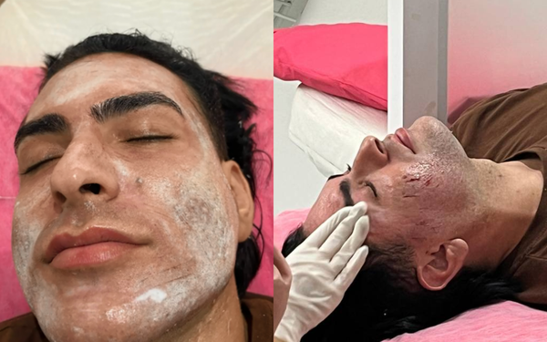 Henrique Chagas com ferimentos no rosto após peeling de fenol