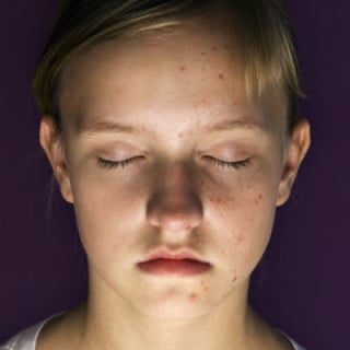 Pele com acne - foto: Getty Images