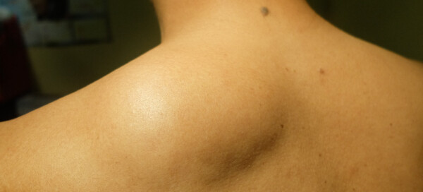 Homem com nódulo protuberante (lipoma) nas costas