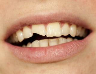 Por mais que corrigir uma fratura dental possa parecer apenas uma questão estética, o dente fraturado pode trazer uma série de problemas