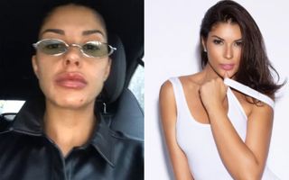 Veja o antes e depois da harmonização facial Denise Queiroz