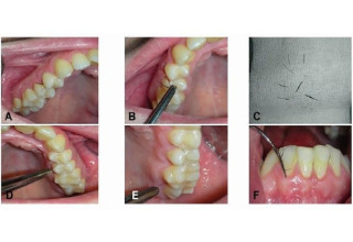 Processo de remoção de alguns pelos na gengiva da jovem - Foto: Revista Oral Surgery, Oral Medicine, Oral Pathology and Oral Radiology