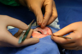 A cirurgia de blefaroplastia deve ser feita no hospital- foto: Getty Images