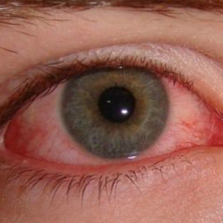 Olhos vermelhos - Foto: Pinterest