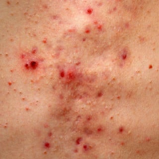 Acne grave - foto: Getty Images