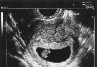 Imagem de ultrassonografia de gravidez com seis semanas.
