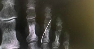 Médicos descobrem agulha no interior do pé de idosa