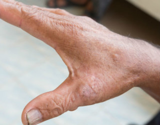 A artrite psoriásica é uma doença inflamatória diretamente ligada à psoríase 