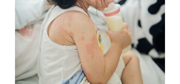 O que melhora a alergia na pele?