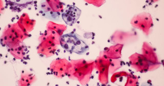Como o HPV pode levar ao câncer de colo de útero