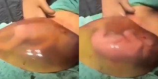 Vídeo mostra bebê dentro da bolsa após o nascimento