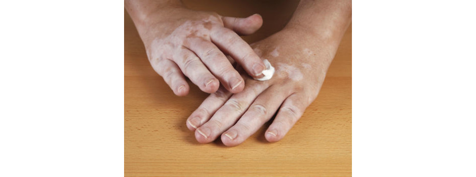 Vitiligo tem tratamento, mas é preciso que o médico avalie as melhores opções