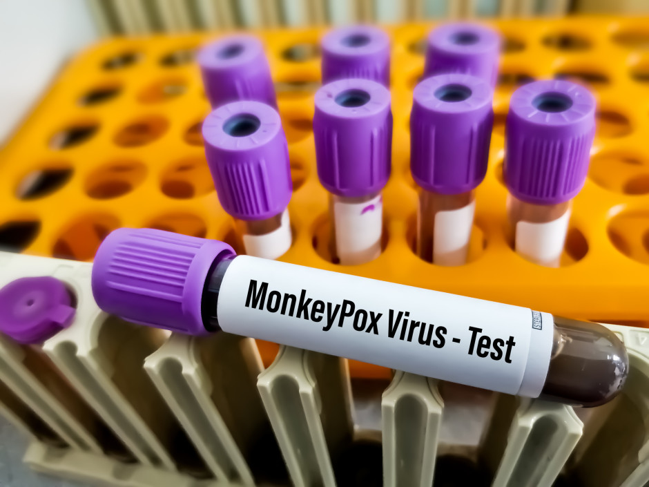 Amostras coletadas para teste de varíola dos macacos