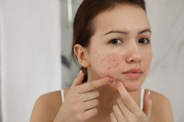 Mulher jovem com espremendo acne no rosto