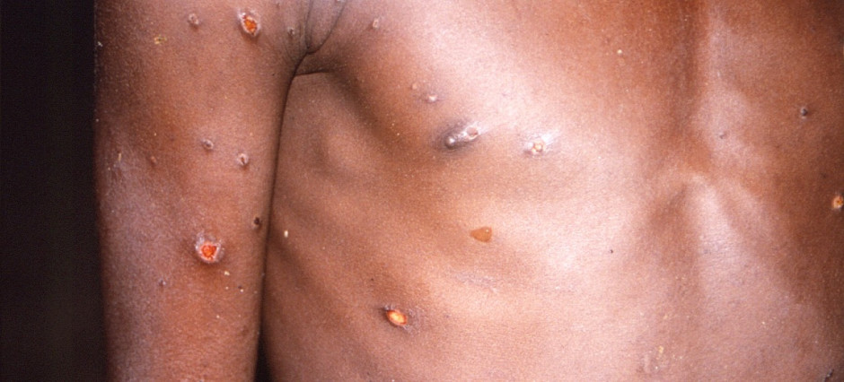Foto aproximada de corpo de criança com lesões na pele causadas pela varíola dos macacos