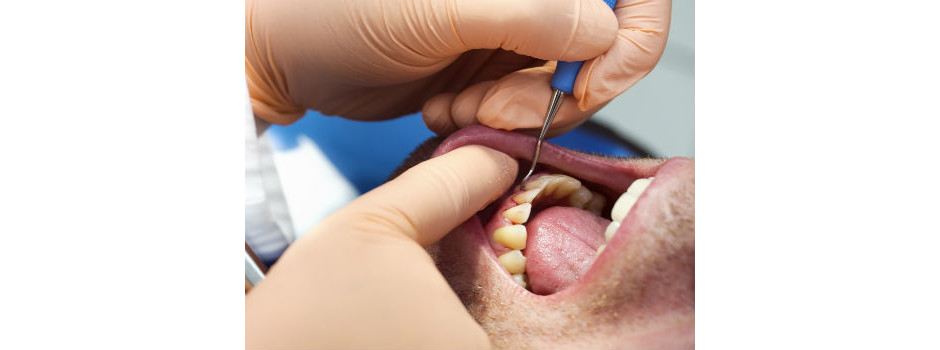 Os principais sintomas da gengivite são sangramento durante a escovação e uso do fio dental, inchaço e sensibilidade.