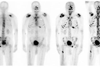 Figura mostra múltiplos focos do câncer de próstata acometendo os ossos - metástases.