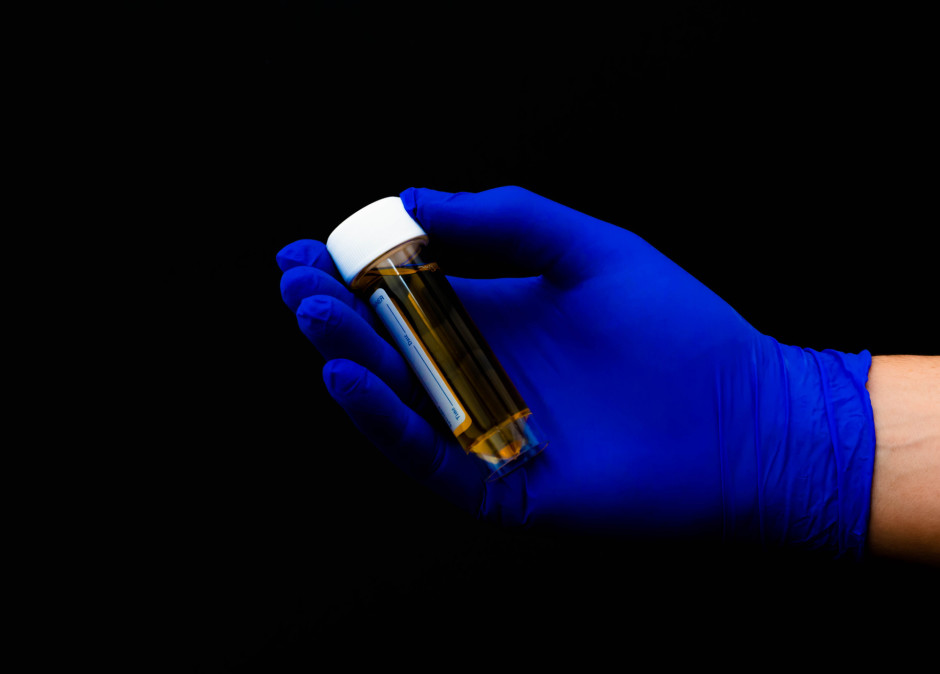 Foto aproximada de médico segurando uma amostra de urina com cor escura