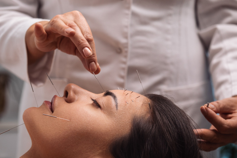 Mulher deitada fazendo tratamento de acupuntura