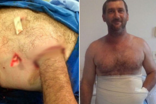 Homem teve mão colocada dentro da barriga para evitar amputação - Foto: Reprodução DailyMail