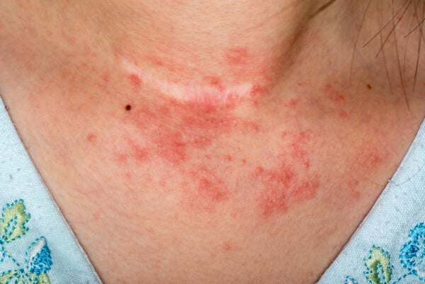 imagem aproximada de um pescoço com manchas vermelhas e erupções devido a dermatite de contato