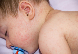 Bebês com sarampo podem chegar a óbito - Foto: Shutterstock