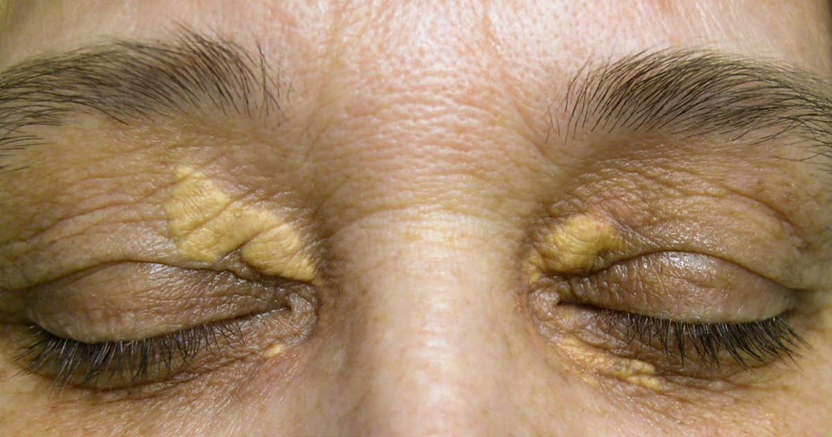 Plantas Que Curam Xantelasma - BRAINCP