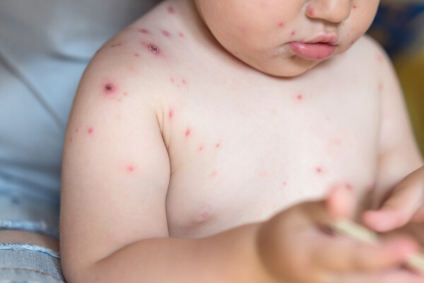 Bebê com lesões na pele, um dos sintomas de varíola dos macacos