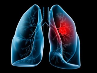 Projeto Inspire busca acelerar o diagnóstico de câncer de pulmão