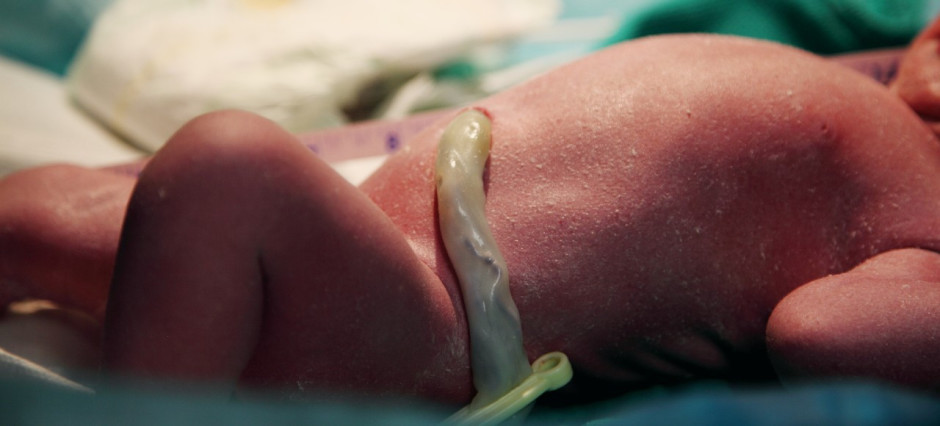bebê recém-nascido com o cordão umbilical