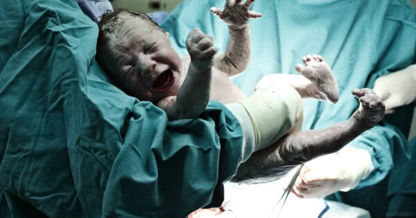 Imagem de bebê nascendo através de parto cesariano