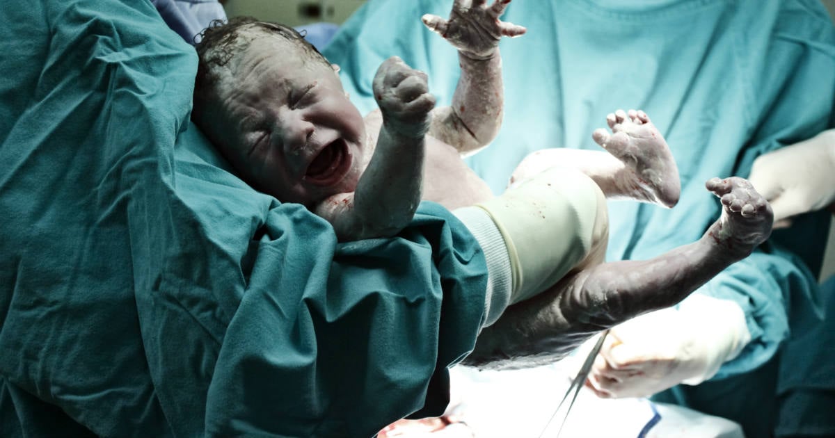 Cesariana (parto cesárea): como é feita, vantagens e riscos - Minha Vida