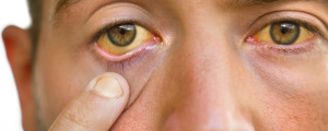Foto aproximada de homem com olhos amarelados devido icterícia