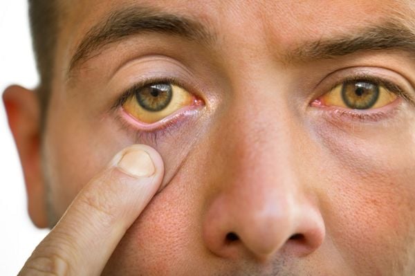 Foto aproximada de homem com olhos amarelados devido icterícia