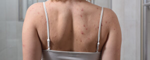 Mulher com acne na pele das costas