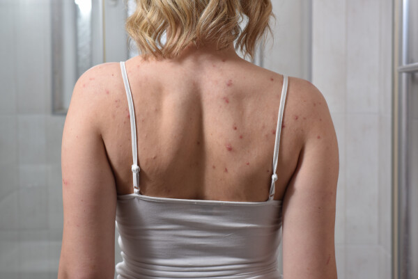 Mulher com acne na pele das costas