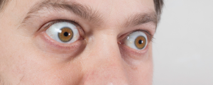 Homem com os olhos esbugalhados devido a exoftalmia