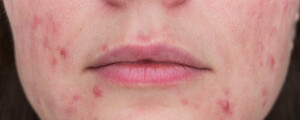 Imagem aproximada de mulher com pápulas no rosto, ao redor da boca