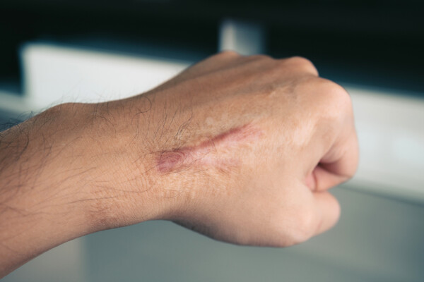 Cicatriz com queloide em mão masculina