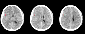 tomografia computadorizada do cérebro