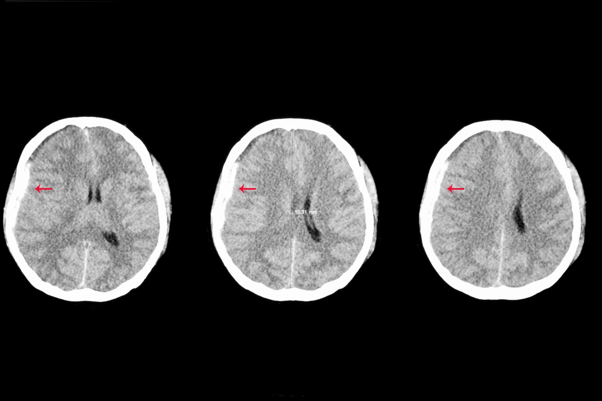 Hematoma subdural: o que é, tipos, causas e tratamento - Minha Vida🐍 ...