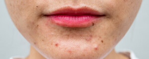 Imagem do rosto de uma mulher com acne