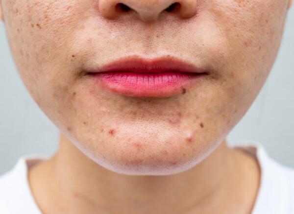 Imagem do rosto de uma mulher com acne