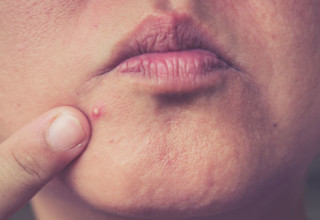 Acne com pápulas inflamadas e pus (grau 2) - Foto: Shutterstock