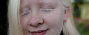 Imagem aproximada do rosto de uma menina com albinismo. Ela está de olhos fechados