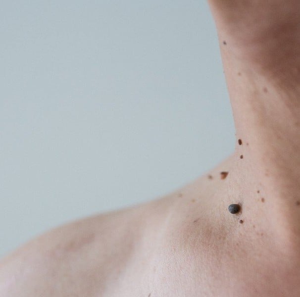Caroços na pele: o que podem ser e tratamento - Minha Vida