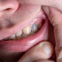 Dentes com cores anormais