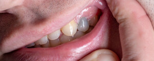 Homem mostrando dente com cor acinzentada